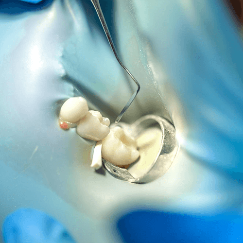 Atraumatic Tooth Extraction